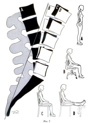 X-ray tracing of the lumbar spine showing flexion in different positions