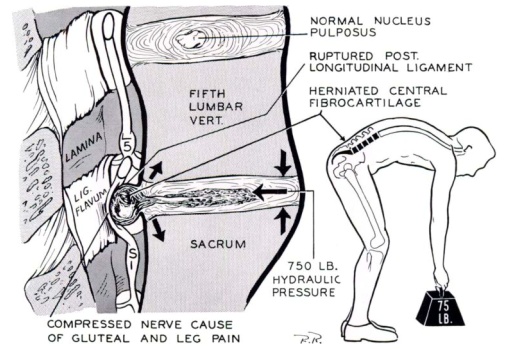 Image showing an intervertebral disc getting pushed out through spine flexion